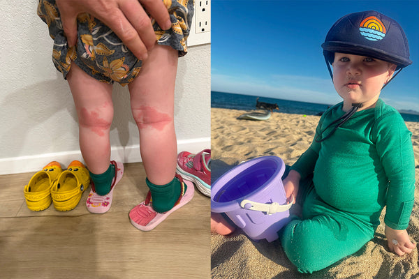 Eczema and Merino Wool